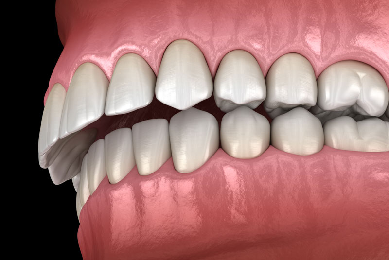 malocclusion graphic