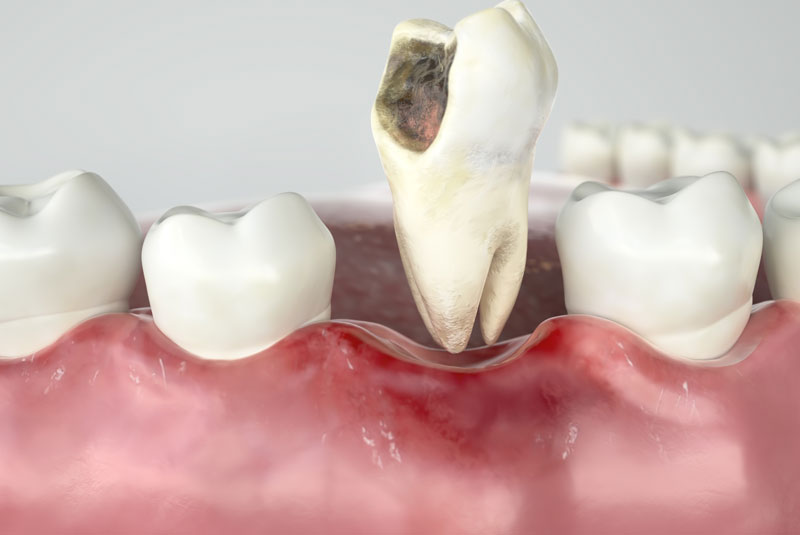 tooth decay graphic