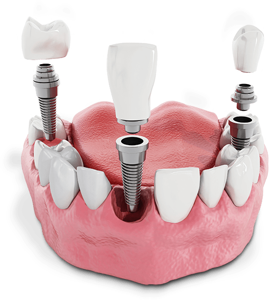 Multiple Dental Implants Above A Gumline