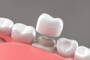 Dental implant, Fixing missing teeth with metal screw, teeth crown treatment 3D rendering.