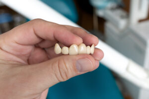 The dentist holds a ceramic, zirconium, bridge-shaped, non-removable dental prosthesis.