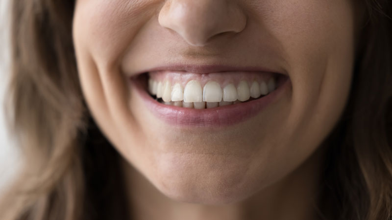 women smiling with white teeth